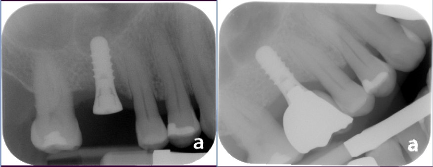 Burnaby Periodontist Bunraby Sinus lift IMPrESS Perio Implant Dr. Noroozi