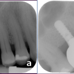 Burnaby Periodontist Bunraby Sinus lift IMPrESS Perio Implant Dr. Noroozi