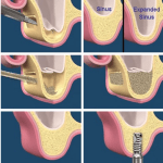Sinus Lift Implant Vancouver Burnaby Periodontist Implant Dentist IMPreESS Perio