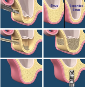 Sinus Lift Implant Vancouver Burnaby Periodontist Implant Dentist IMPreESS Perio