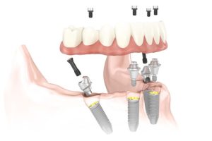 All-On-Four Implant Teeth in One Day Vancouver Burnaby BC