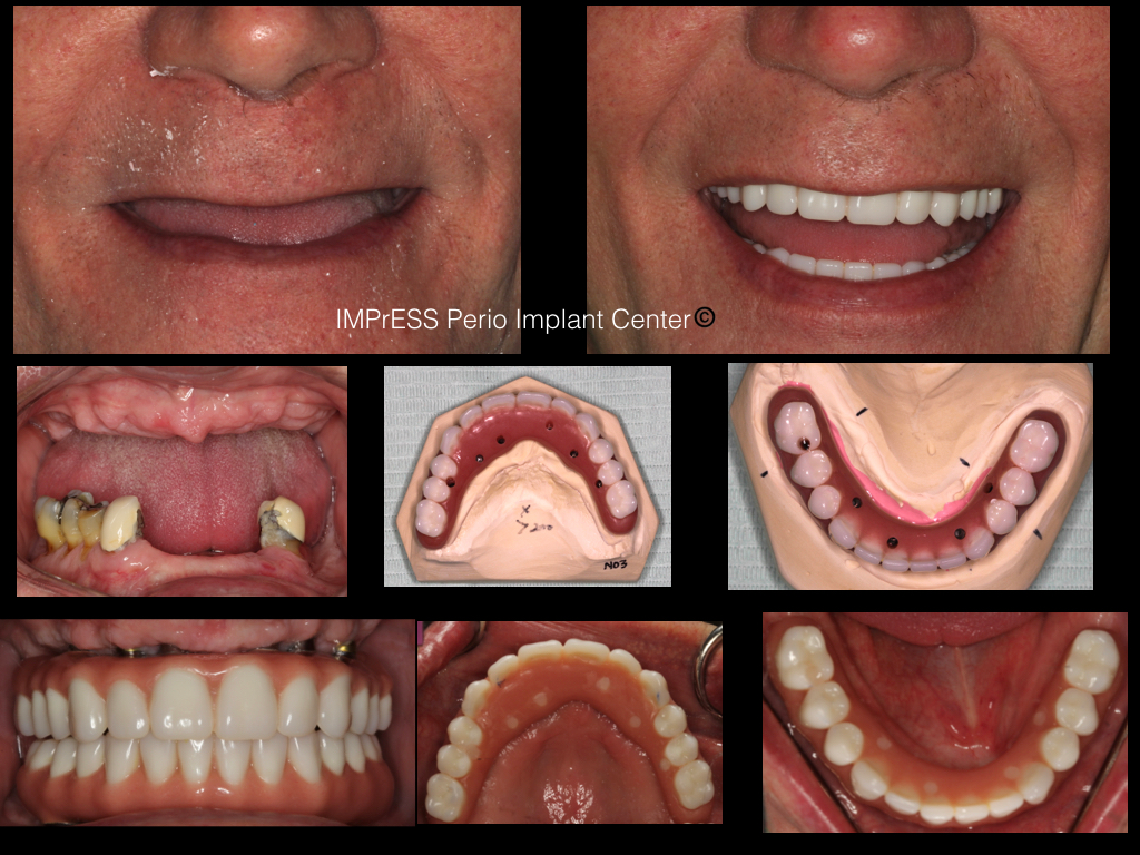 All  on  4   implants  Teeth in one day full mouth dental implants Implant teeth impress perio Dr. Noroozi