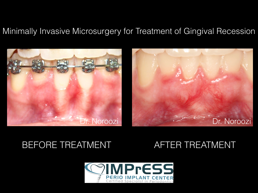 Braces Gum Recession Treatment Best Periodontist in Vancouver BC Dr. Noroozi IMPrESS Perio
