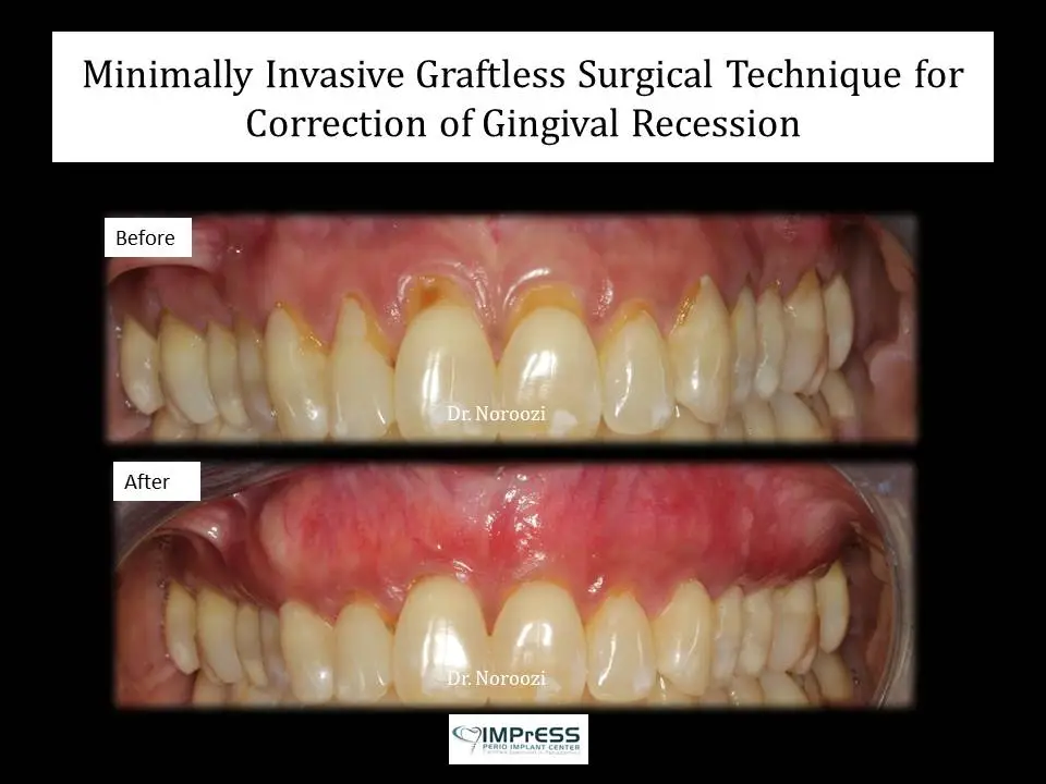 Gum Graft Alternative Pinhole Surgical Technique Alloderm Dr. Noroozi Periodontist Vancouver