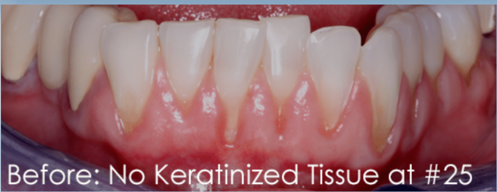 Pinhole Gum Rejuvenation Dr. Mehdi Noroozi Burnaby Periodontist IMPrESS Perio Implant Center