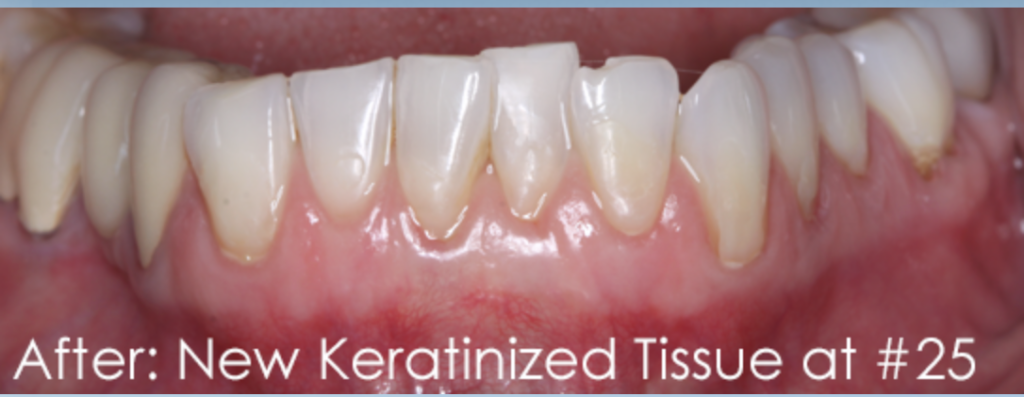 Pinhole Gum Rejuvenation Dr. Mehdi Noroozi Burnaby Periodontist IMPrESS Perio Implant Center