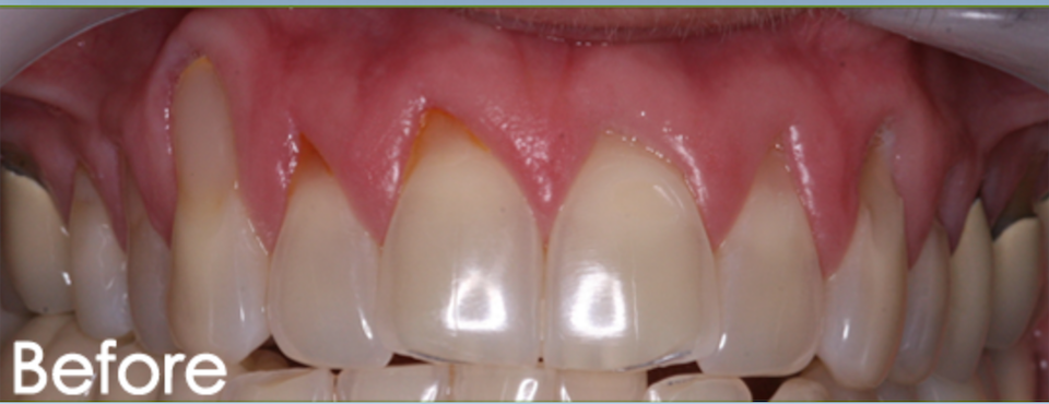 Pinhole Gum Rejuvenation Dr. Mehdi Noroozi Burnaby Periodontist