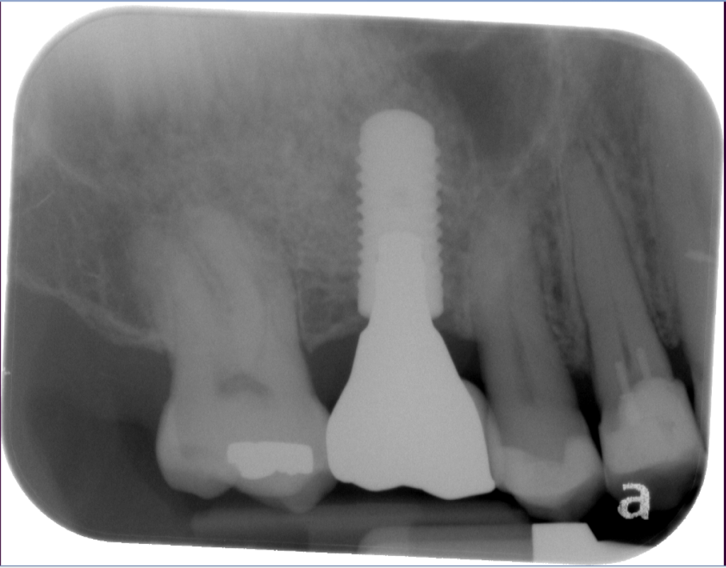 IMPrESS Perio Sinus Lift