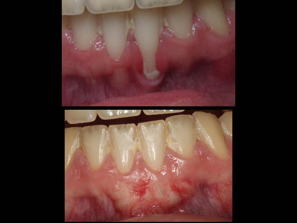 Vancouver Gum Grafting Vancouver Gum Specialist IMPrESS Perio Implant Center