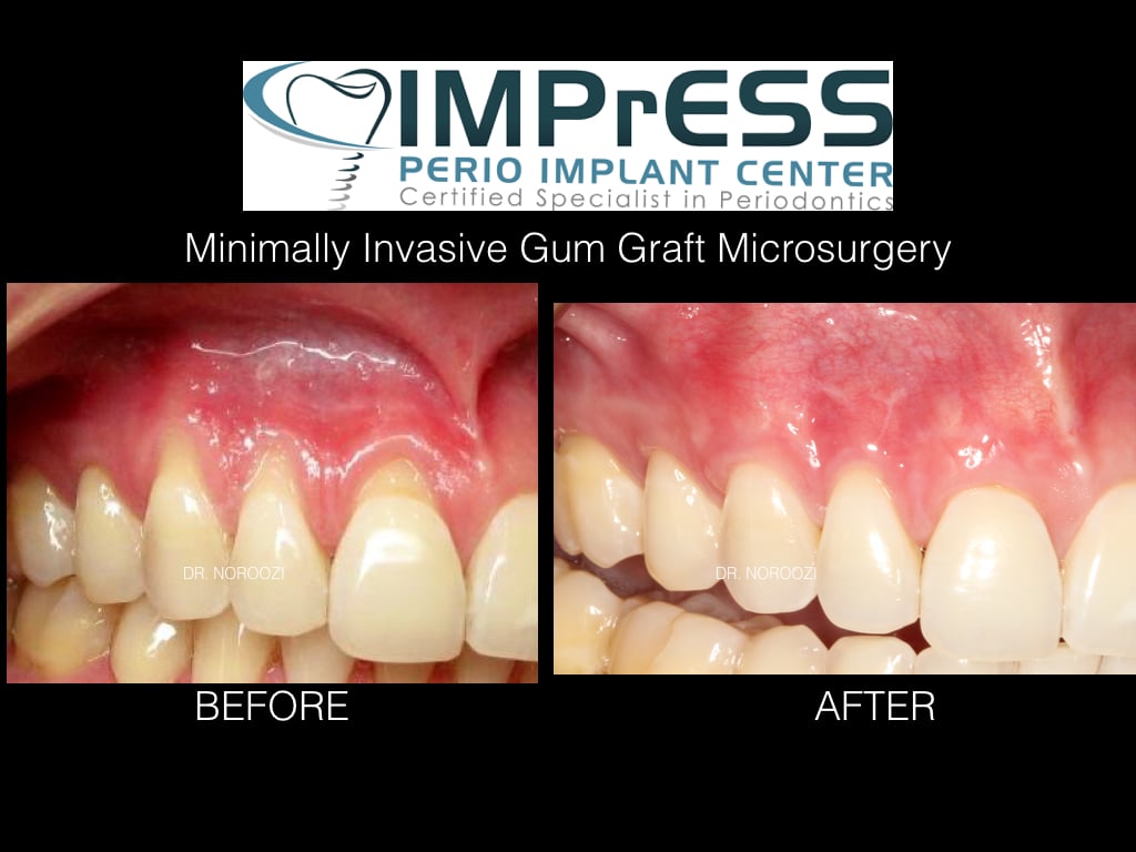 Best gum graft in Vancouver Burnaby Dr. Noroozi Periodontist  IMPrESS  Perio  Implant  Center