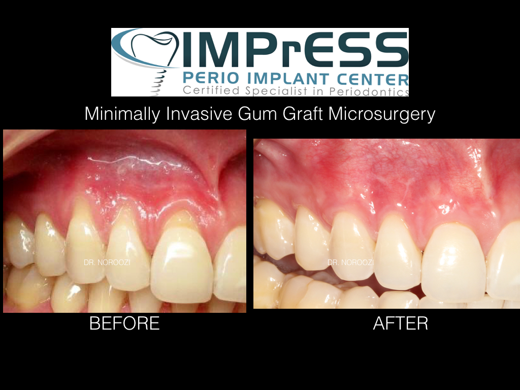 Best gum graft in Vancouver Burnaby Dr. Noroozi Periodontist IMPrESS Perio Implant Center