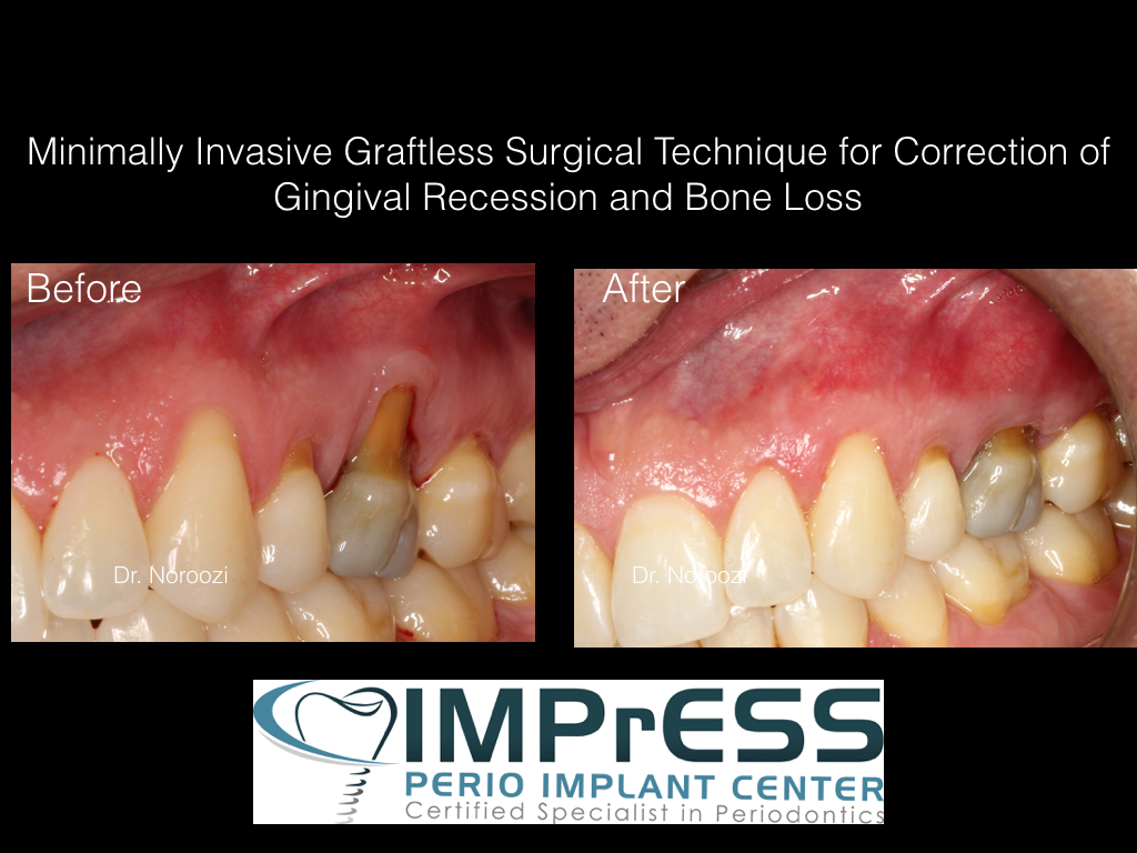 Pinhole Surgical Technique Gum Graft Alternative Burnaby IMPrESS Perio Implant Center