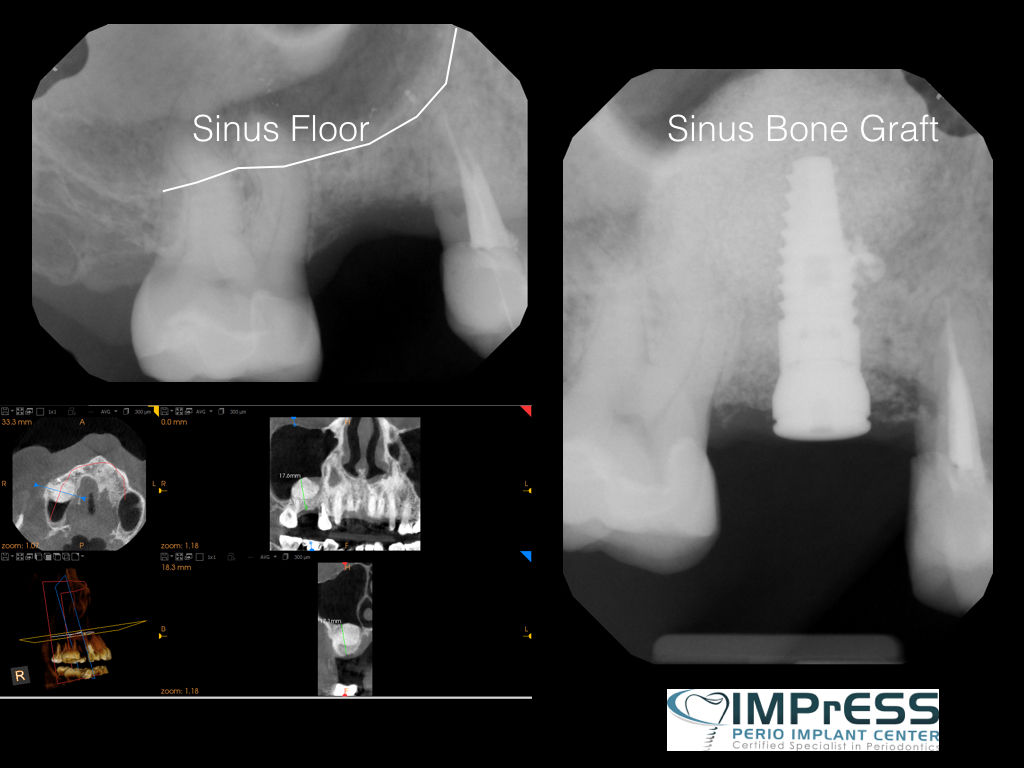 Sinus Lift Surgery to replace upper back teeth IMPrESS Perio Implant Center