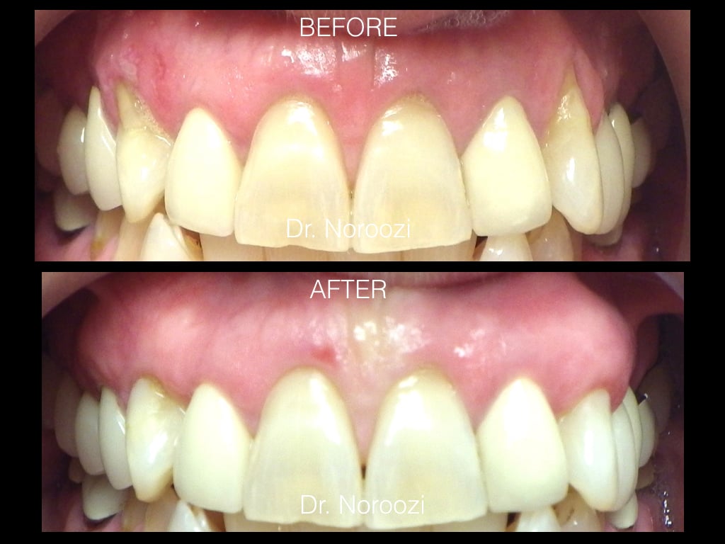 Gum Grafting for Gum Recession Vancouver Periodontist IMPrESS Perio