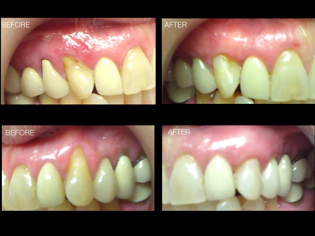 Gum Grafting for Gum Recession Vancouver Periodontist IMPrESS Perio