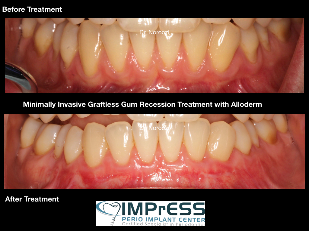 Gum Graft Alternative Gum Recession Reversal Pinhole Surgical technique Dr. Noroozi Periodontist