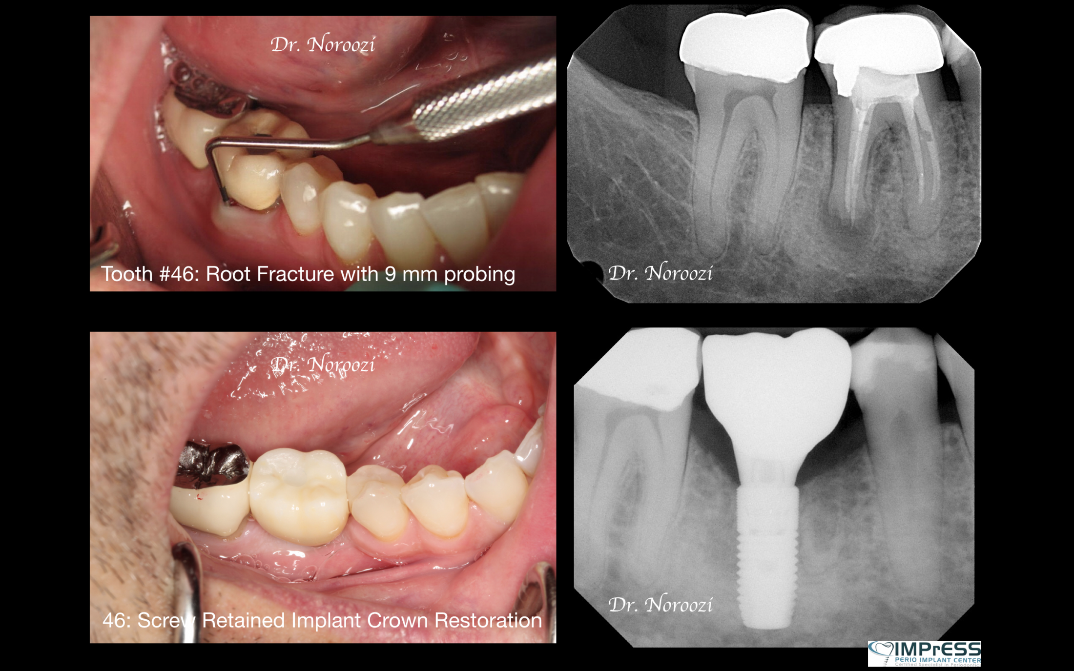 Best Dental Implant Dentist Specialist IMPrESS Perio Implant Center Dr. Noroozi Vancouver Periodontist