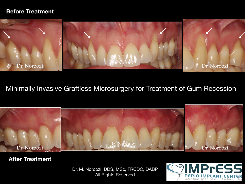 Pinhole Gum Surgery Gum Graft Alternative Alloderm Vancouver Periodontist Dr. Noroozi IMPrESS Perio Implant Center Gum Recession Treatment