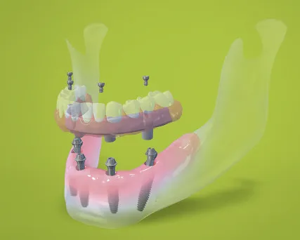 All on Four Dental Implants Vancouver Burnaby BC Dr. Noroozi All on 4 Teeth in One Day