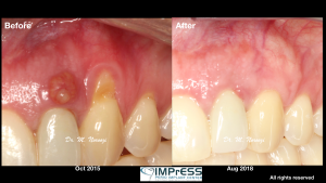 Best Periodontist in Vancouver BC Best Gum Graft Gum recession treatment Burnaby Periodontist Dr. Noroozi IMPrESS Perio Implant Center
