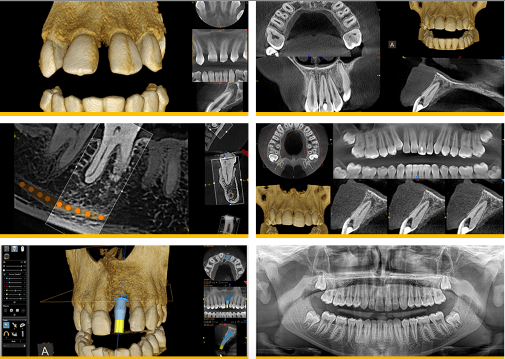 Dental CT Scan Vancouver Burnaby BC