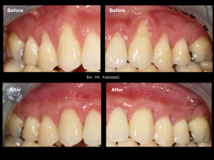 Gum Graft alternative pinhole surgical technique vancouver bc periodontist alloderm