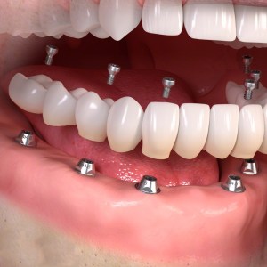 Fixed Implant Denture Burnaby BC IMPrESS Perio Implant Center