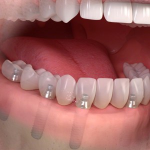 Vancouver Implant Specialist Dr. Noroozi IMPrESS Perio