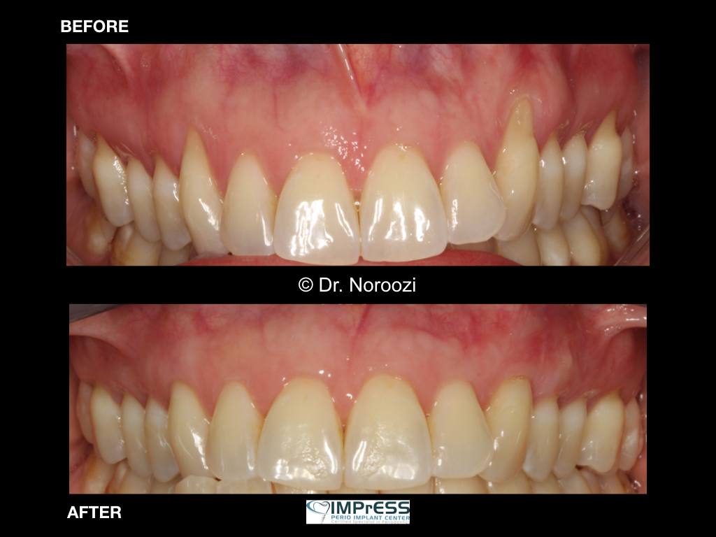 Best Gum Graft Alternative with Dermal graft to treat gum recession Dr. Noroozi Vancouver Periodontist IMPrESS Perio Implant