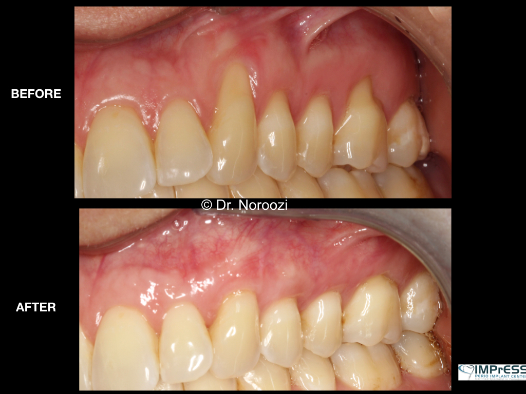 Pinhole  Surgical  Technique  Vancouver  Burnaby  BC  Canada  Best Gum Graft Alternative with Dermal graft to treat gum recession Dr. Noroozi Vancouver Periodontist IMPrESS Perio Implant