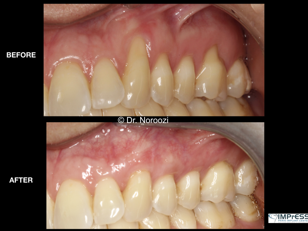 best gum graft for treatment of receding gums Vancouver BC best periodontist Dr. Noroozi IMPrESS Perio