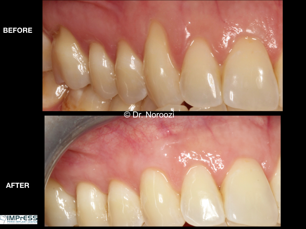 Best Gum Graft Alternative with Dermal graft to treat gum recession Dr. Noroozi Vancouver Periodontist IMPrESS Perio Implant