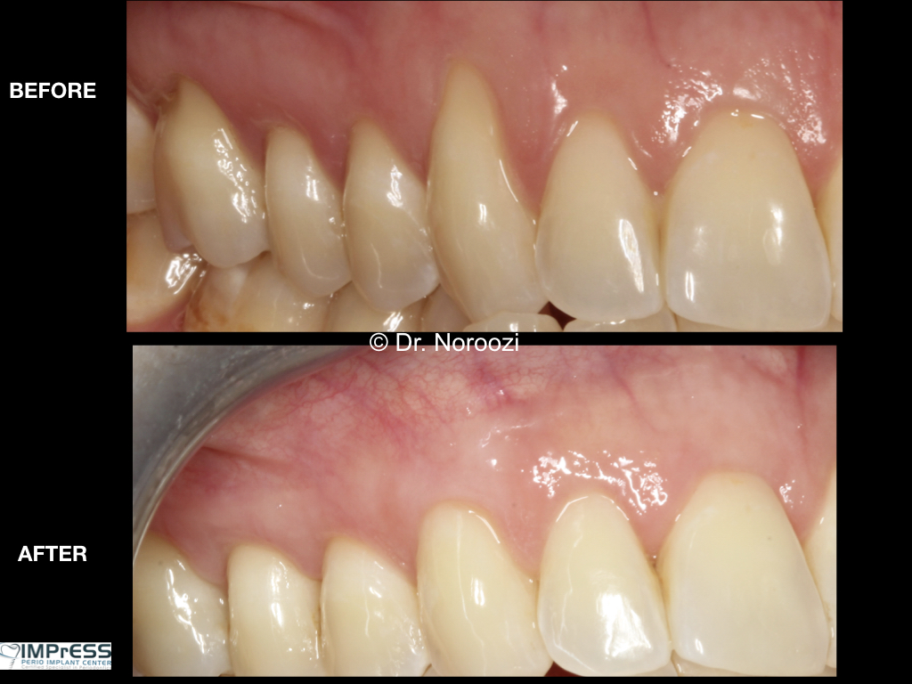 best gum graft for treatment of receding gums Vancouver BC best periodontist Dr. Noroozi IMPrESS Perio