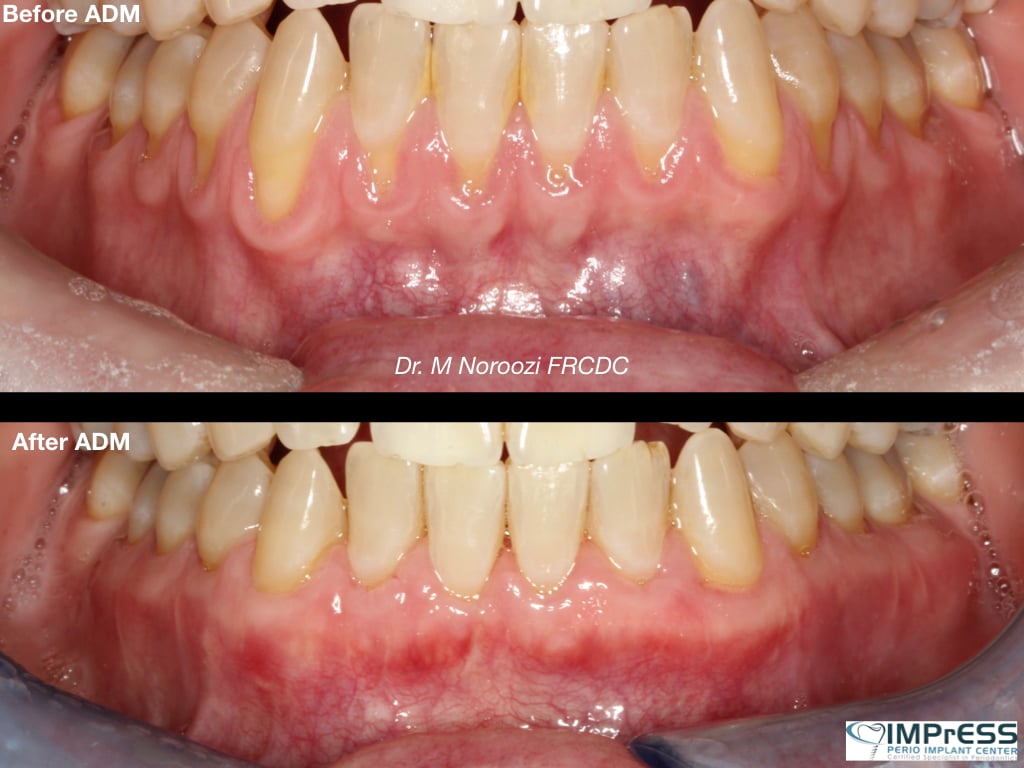 Best Gum Graft Alternative with Dermal graft to treat gum recession Dr. Noroozi Vancouver Periodontist IMPrESS Perio Implant