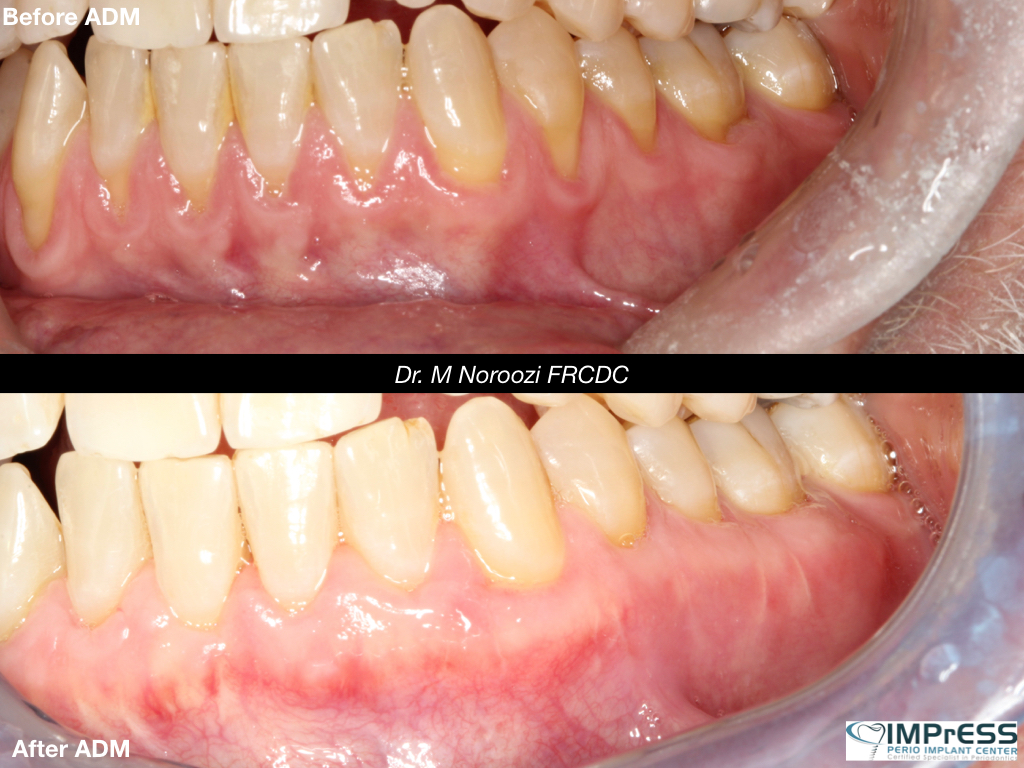 Best Gum Graft Alternative with Dermal graft to treat gum recession Dr. Noroozi Vancouver Periodontist IMPrESS Perio Implant