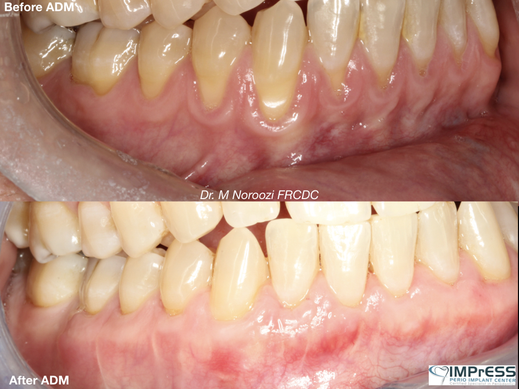 Best Gum Graft Alternative with Dermal graft to treat gum recession Dr. Noroozi Vancouver Periodontist IMPrESS Perio Implant
