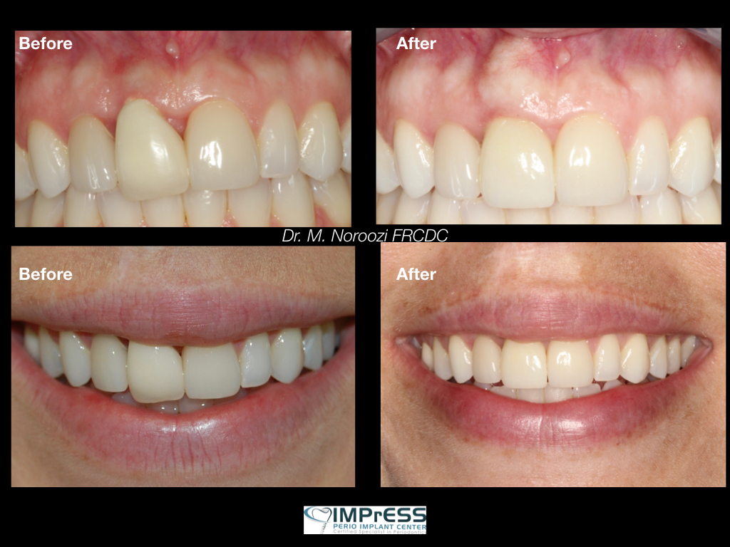 Best Implant Dentist Dr. Noroozi Vancouver Periodontist Implant tooth vancouver best implant dentist BC Canada