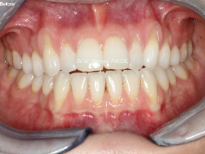 Gum Graft Alternative Pinhole Gum Rejuvenation Allograft Dermal Matrix Vancouver Periodontist Dr. Noroozi