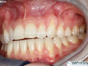 Gum Graft Alternative Pinhole Gum Rejuvenation Allograft Dermal Matrix Vancouver Periodontist Dr. Noroozi