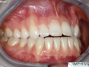 Gum Graft Alternative Pinhole Gum Rejuvenation Allograft Dermal Matrix Vancouver Periodontist Dr. Noroozi