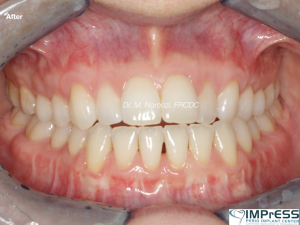 Gum Graft Alternative Pinhole Gum Rejuvenation Allograft Dermal Matrix Vancouver Periodontist Dr. Noroozi