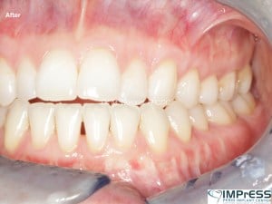 Gum Graft Alternative Pinhole Gum Rejuvenation Allograft Dermal Matrix Vancouver Periodontist Dr. Noroozi