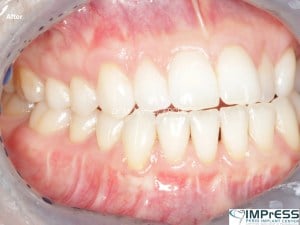 Gum Graft Alternative Pinhole Gum Rejuvenation Allograft Dermal Matrix Vancouver Periodontist Dr. Noroozi