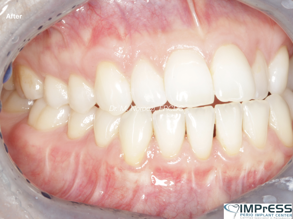 Gum Graft Alternative Pinhole Gum Rejuvenation Allograft Dermal Matrix Vancouver Periodontist Dr. Noroozi