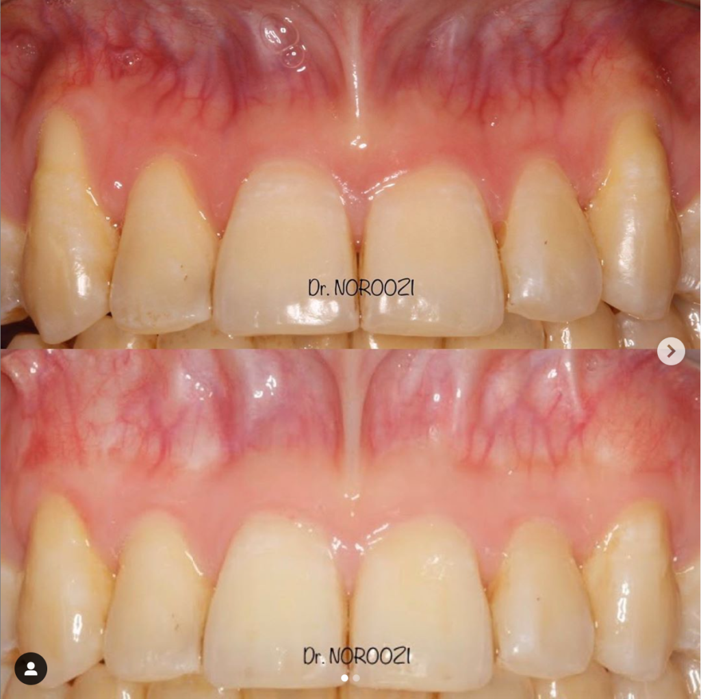 Best Gum Graft for Gum Recession Gum Specialist Vancouver Periodontist IMPrESS Perio Implant Center Dr. Noroozi