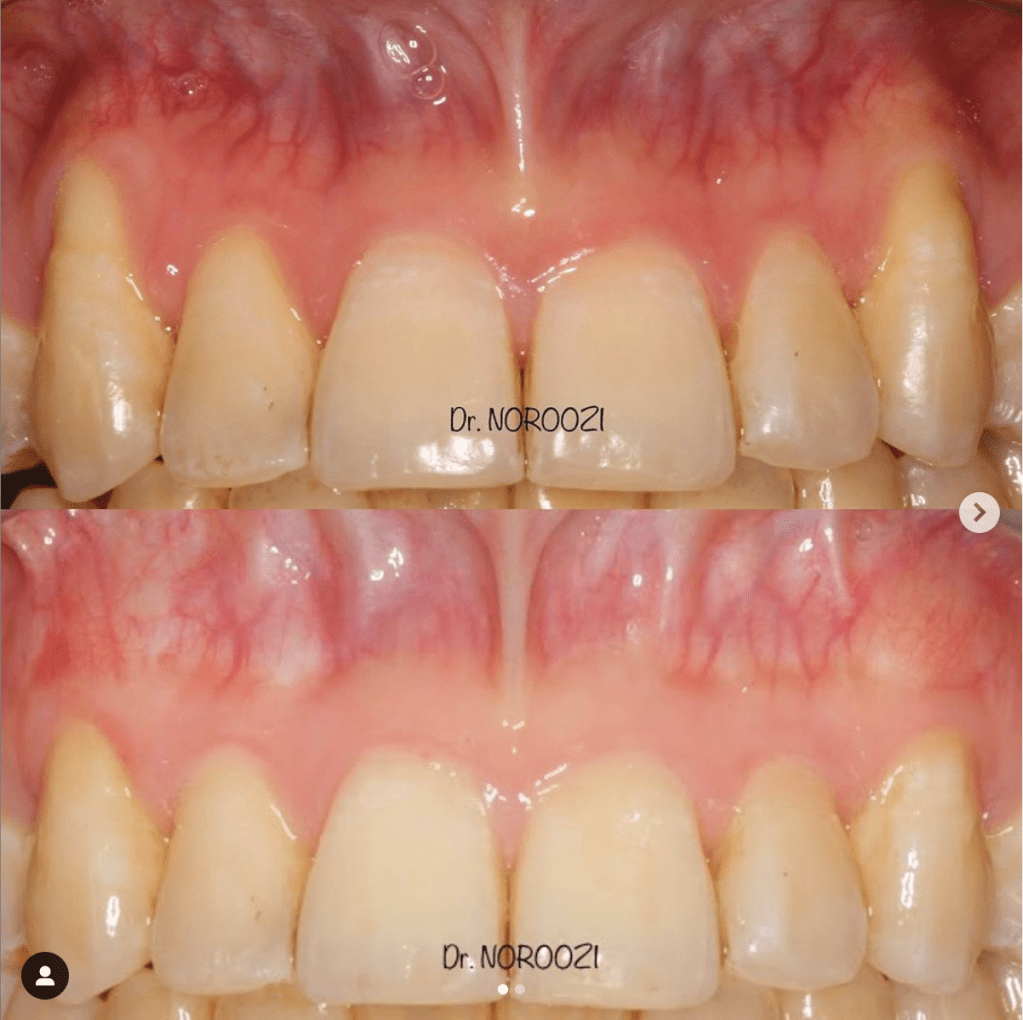 Best Gum Graft for Gum Recession Gum Specialist Vancouver Periodontist IMPrESS Perio Implant Center Dr. Noroozi