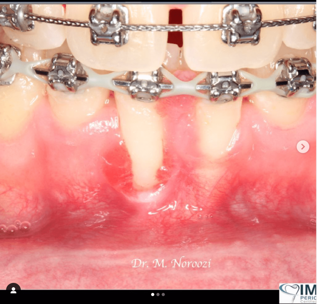 Gum recession treatment in Burnaby BC near Vancouver Best Periodontist Dr. Noroozi IMPrESS Perio Implant Center