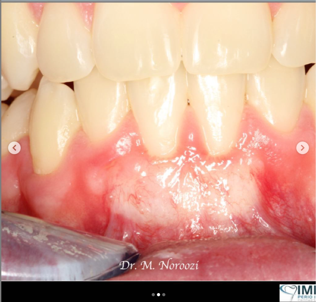 Gum recession treatment in Burnaby BC near Vancouver Best Periodontist Dr. Noroozi IMPrESS Perio Implant Center