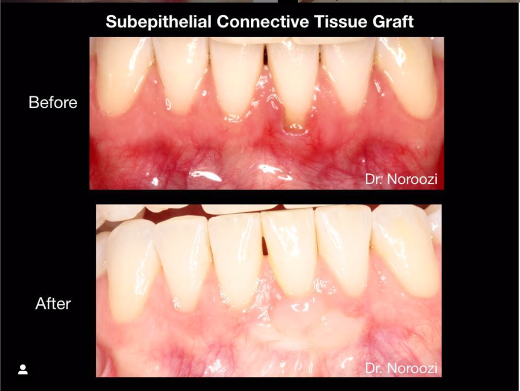 Best Gum Graft in Vancouver Burnaby BC