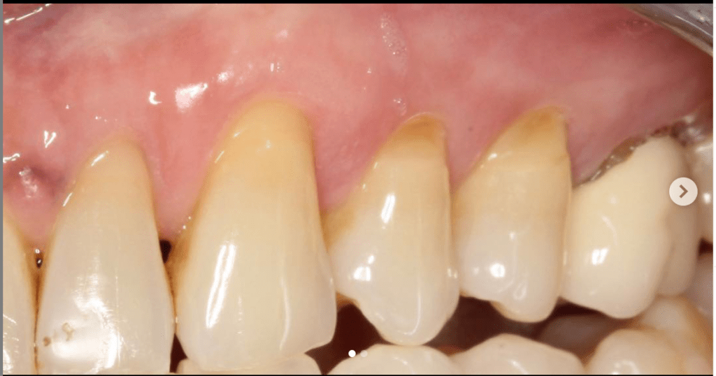 Gum recession treatment in Burnaby BC near Vancouver Best Periodontist Dr. Noroozi IMPrESS Perio Implant Center